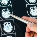 Como a telemedicina pode ajudar em diagnósticos de Epilepsia?